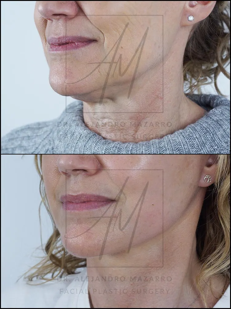 Paciente mujer 55 años - Vista 3/4 izquierda antes y después de Lifting Cervicofacial Deep Plane de Preservación a 7 semanas por el Dr. Alejandro Mazarro en Barcelona.