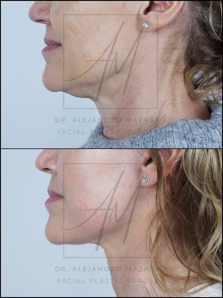 Paciente mujer 55 años - Vista de perfil izquierdo antes y después de Lifting Cervicofacial Deep Plane de Preservación a 7 semanas por el Dr. Alejandro Mazarro en Barcelona.