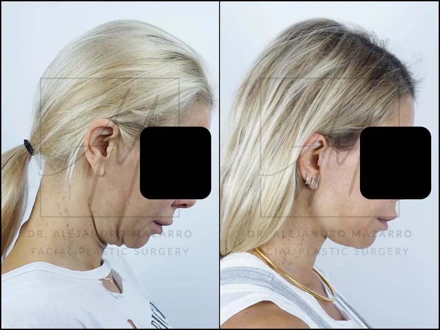 Lifting facial / Deep Plane Facelift- Dr. Mazarro