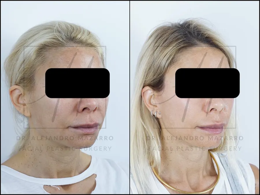 Lifting facial / Deep Plane Facelift- Dr. Mazarro