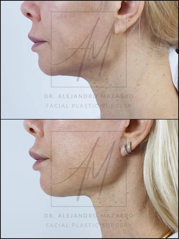 Paciente mujer 45 años - Vista de perfil izquierdo antes y después de Lifting Cervicofacial Deep Plane de Preservación a 9 meses por el Dr. Alejandro Mazarro en Barcelona.
