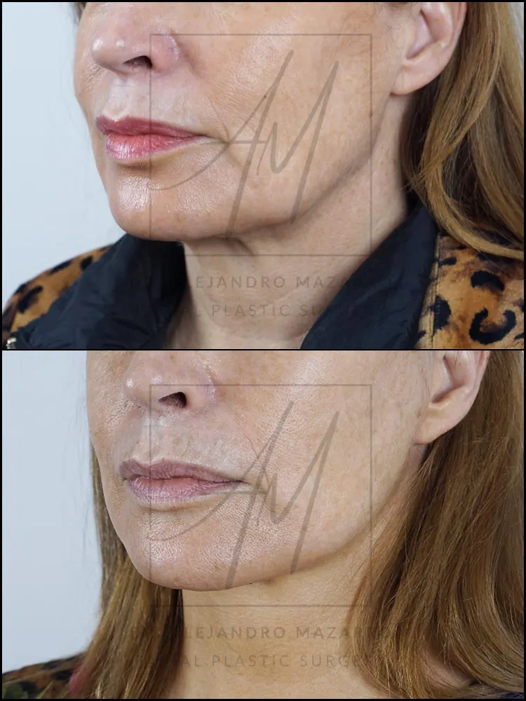 Paciente mujer 53 años - Vista 3/4 izquierda antes y después de Lifting Cervicofacial Deep Plane de Preservación a 4 meses por el Dr. Alejandro Mazarro en Barcelona.