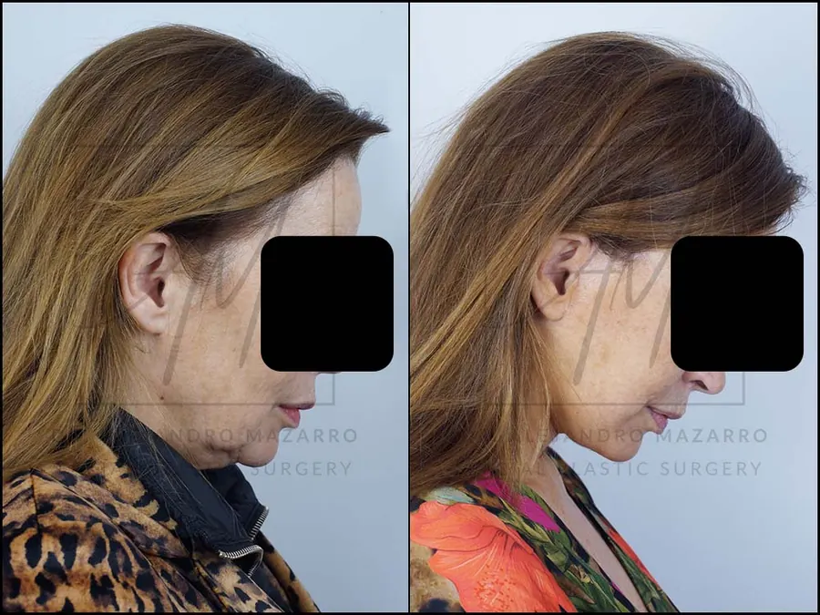 Lifting facial / Deep Plane Facelift- Dr. Mazarro
