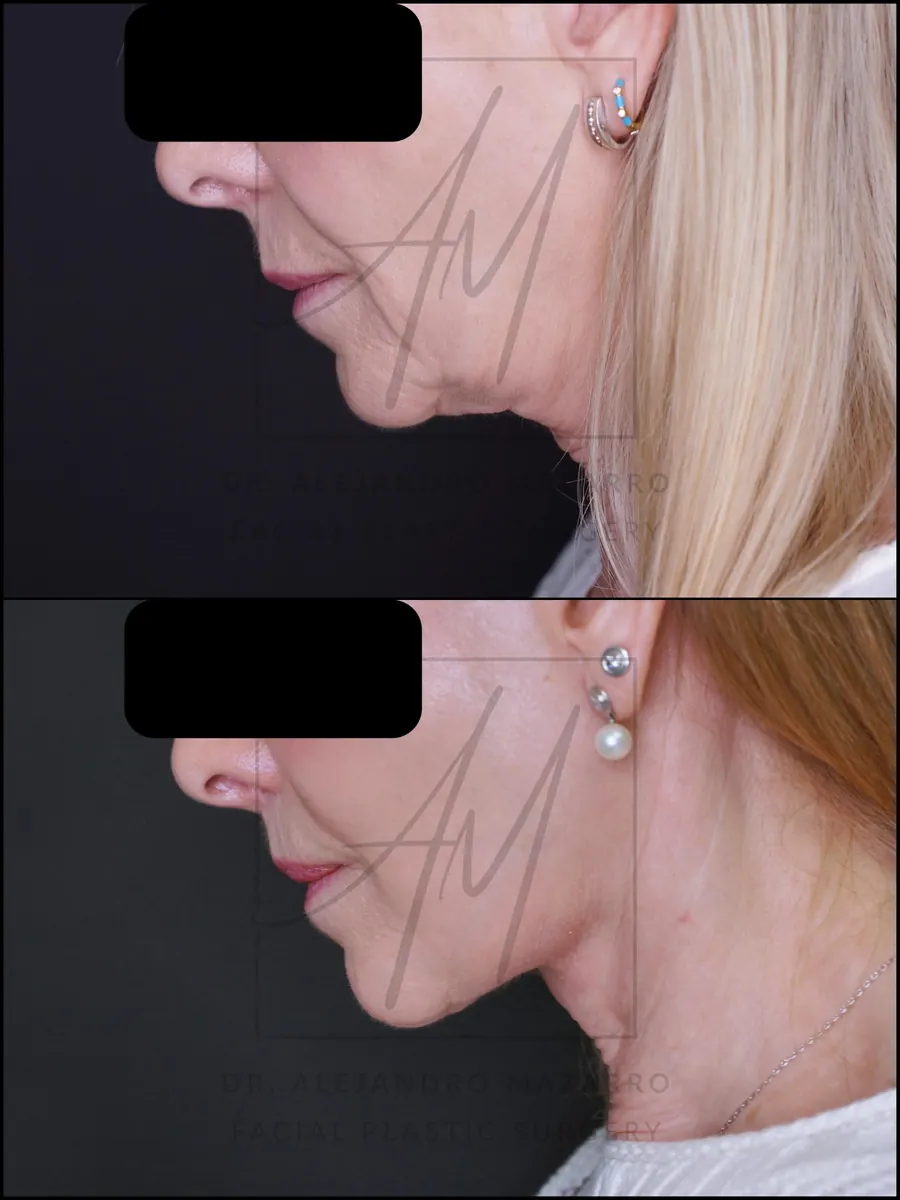 Paciente mujer 67 años - Vista de perfil izquierdo con mentón hacia abajo antes y después de Lifting Cervicofacial Deep Plane de Preservación a 5 meses por el Dr. Alejandro Mazarro en Barcelona.