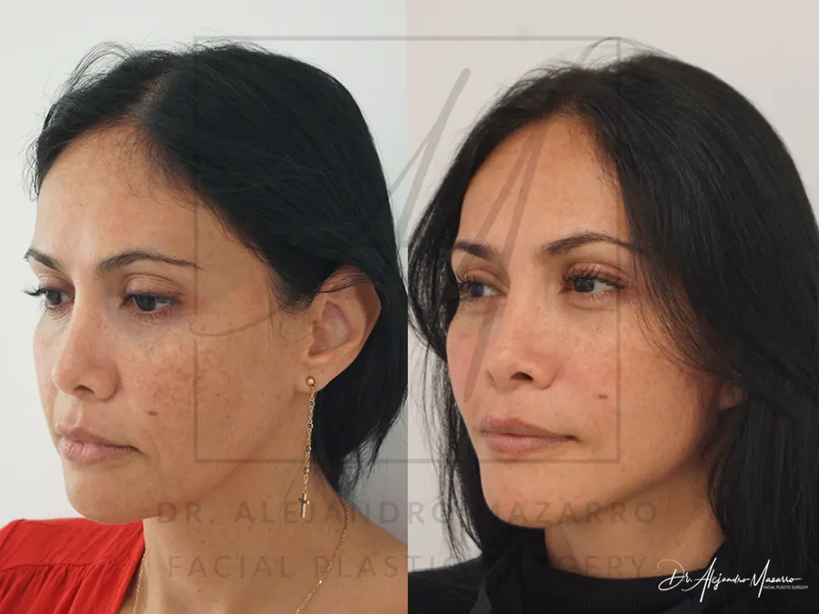 Lifting facial / Deep Plane Facelift- Dr. Mazarro