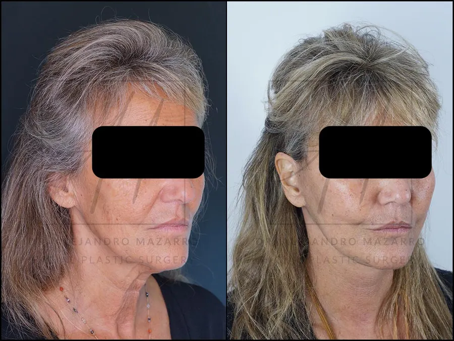 Resultado a las 3 semanas de lifting deep plane de preservación en mujer de 59 años, mostrando rejuvenecimiento facial natural y definición del óvalo. Realizado por el Dr. Mazarro.