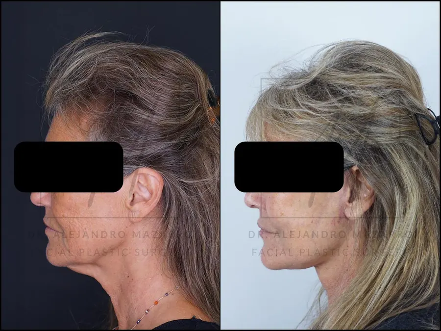 Resultado a las 3 semanas de lifting deep plane de preservación en mujer de 59 años, con óvalo facial rejuvenecido y perfil armónico. Realizado por el Dr. Mazarro.