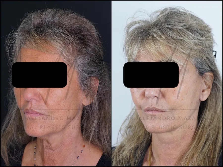3-week result of a preservation deep plane facelift in a 59-year-old woman, with rejuvenated neck and cervical definition. Performed by Dr. Mazarro.