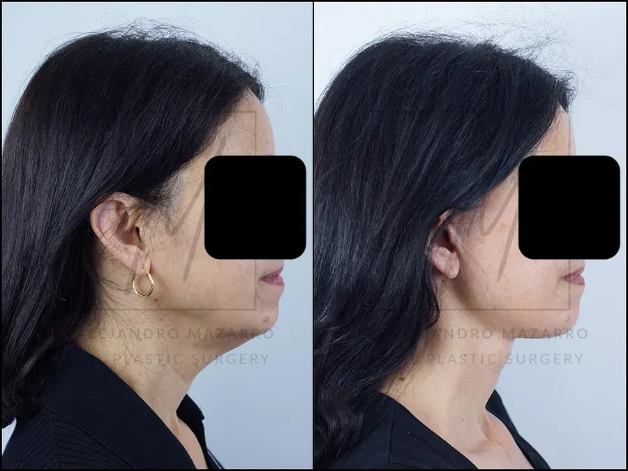 Resultado a los 8 meses de lifting deep plane de preservación y deep neck lift en mujer de 56 años, perfil derecho con contorno facial armonioso y cuello rejuvenecido. Realizado por el Dr. Mazarro.